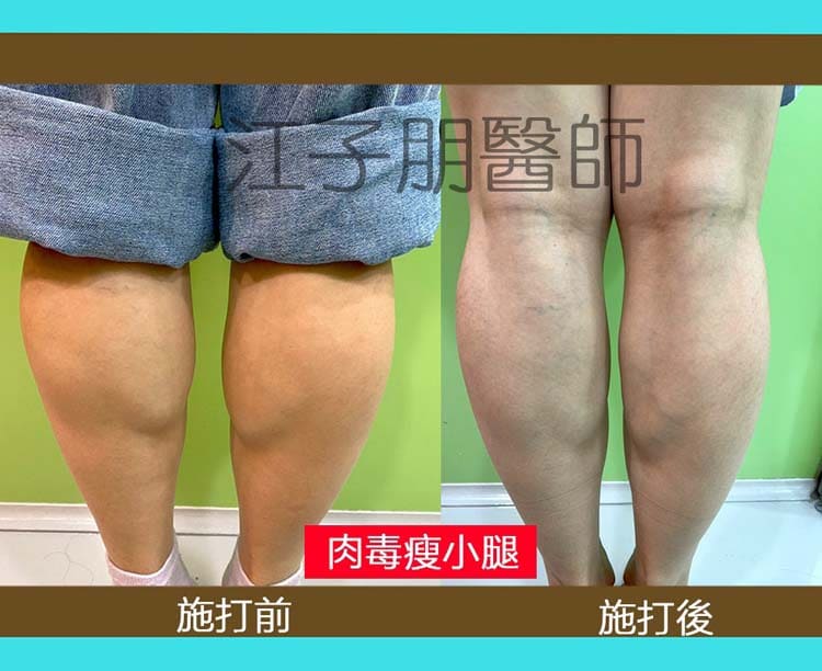 肉毒瘦小腿 施打前後對照