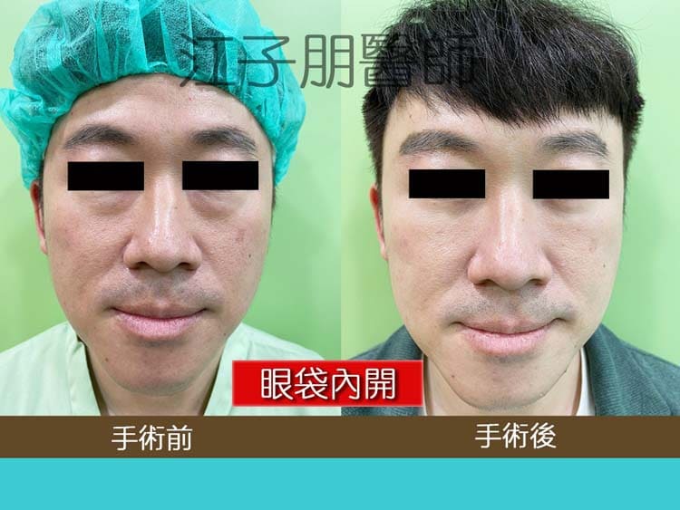眼袋內開 手術前後對照