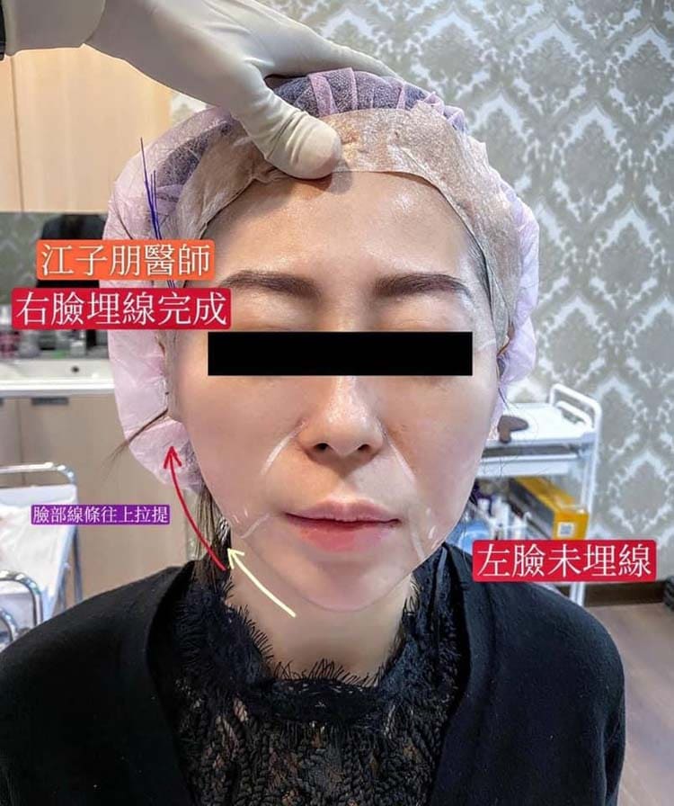 埋線拉提 右臉完成與左臉未埋線對照