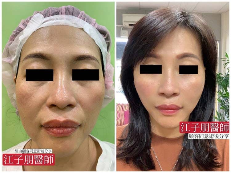 全臉療程 術前術後對照