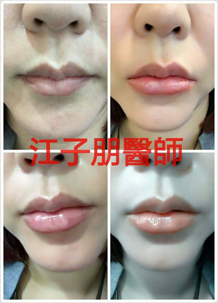 豐唇 術前術後對照