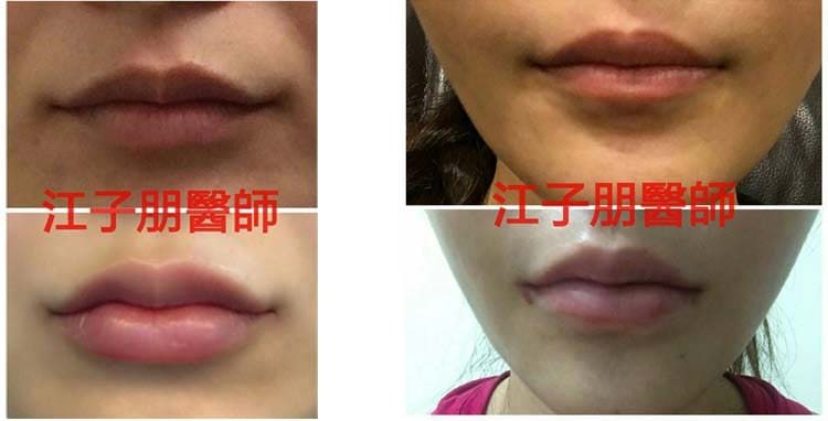 豐唇 術前術後對照