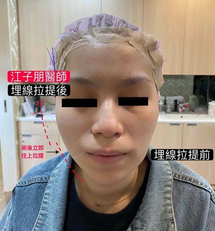 埋線拉提 術後立即往上拉提