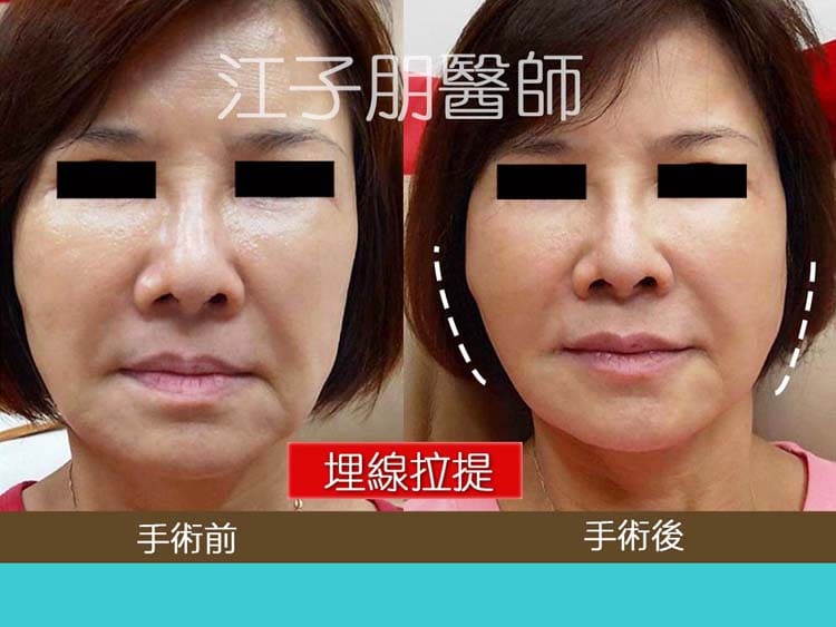 埋線拉提 手術前後對照