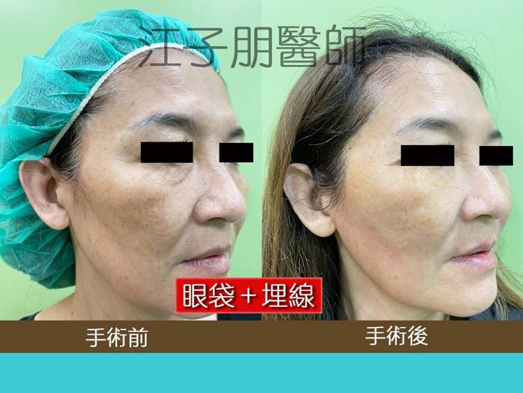 眼袋＋埋線 手術前後對照
