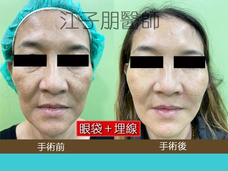 眼袋＋埋線 手術前後對照