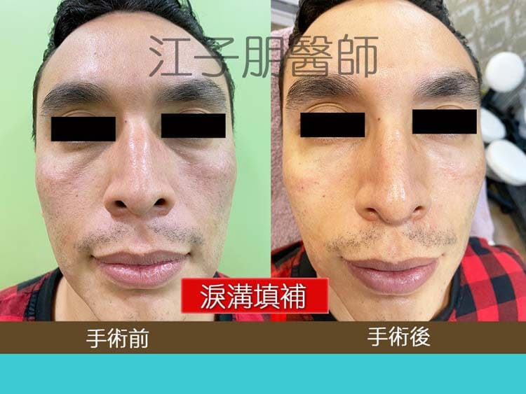 淚溝填補 手術前後對照