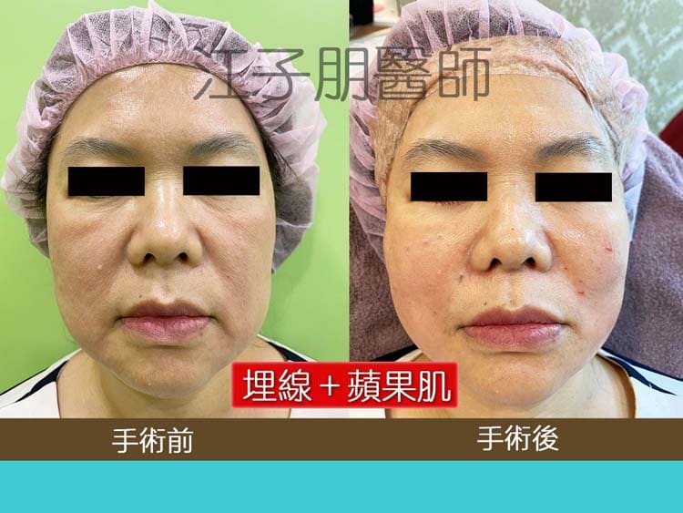 埋線＋蘋果肌 手術前後對照