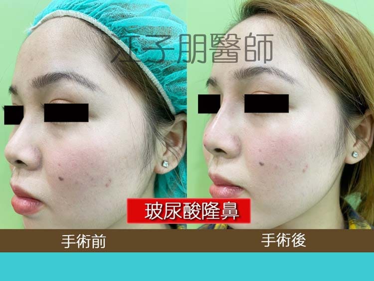 玻尿酸隆鼻 手術前後對照