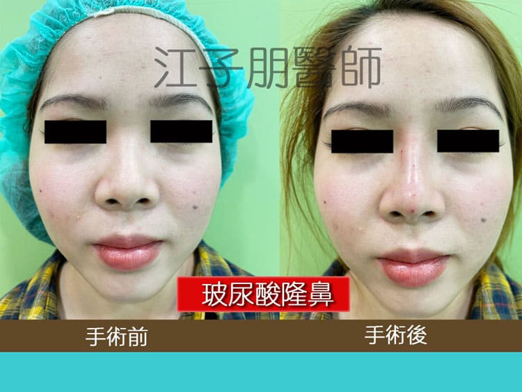 玻尿酸隆鼻 手術前後對照