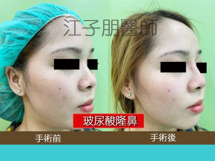 玻尿酸隆鼻 手術前後對照